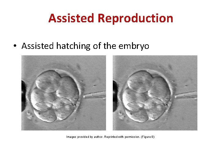 Assisted Reproduction • Assisted hatching of the embryo Images provided by author. Reprinted with