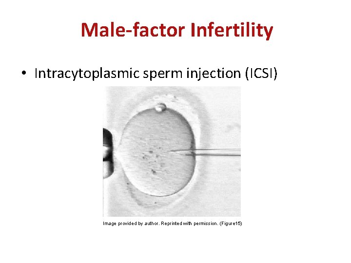 Male-factor Infertility • Intracytoplasmic sperm injection (ICSI) Image provided by author. Reprinted with permission.