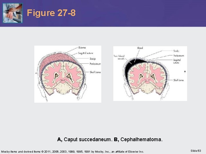 Figure 27 -8 A, Caput succedaneum. B, Cephalhematoma. Mosby items and derived items ©