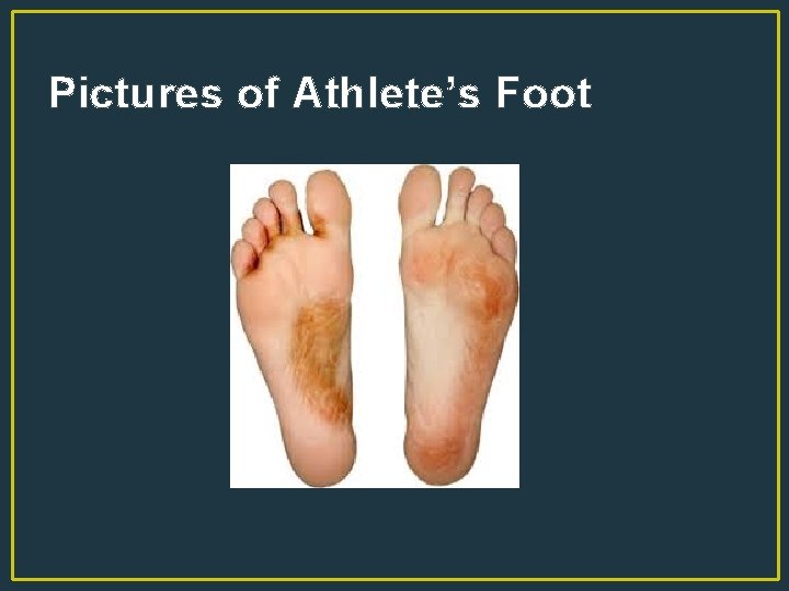 Pictures of Athlete’s Foot 