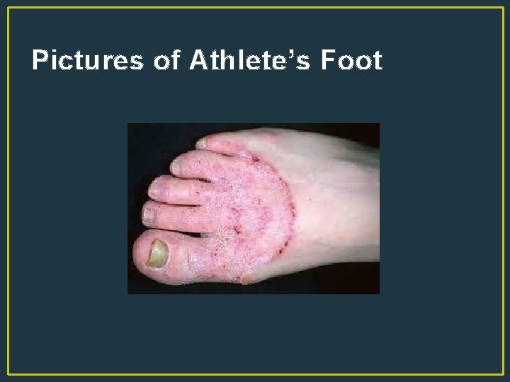 Pictures of Athlete’s Foot 