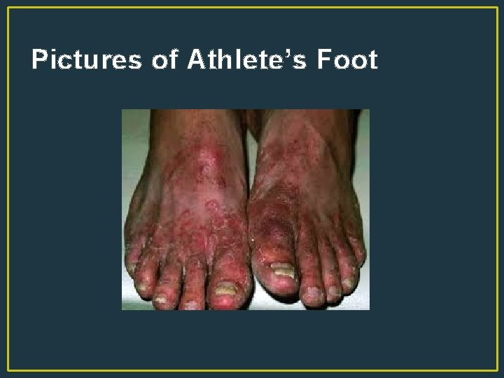 Pictures of Athlete’s Foot 