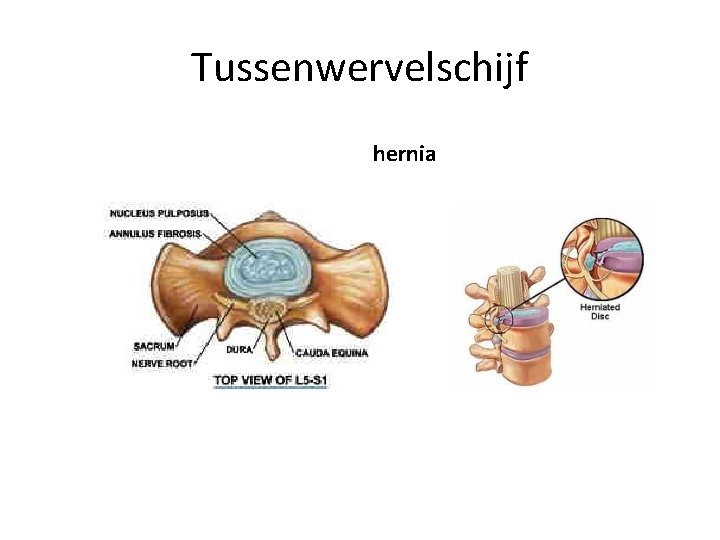 Tussenwervelschijf hernia 