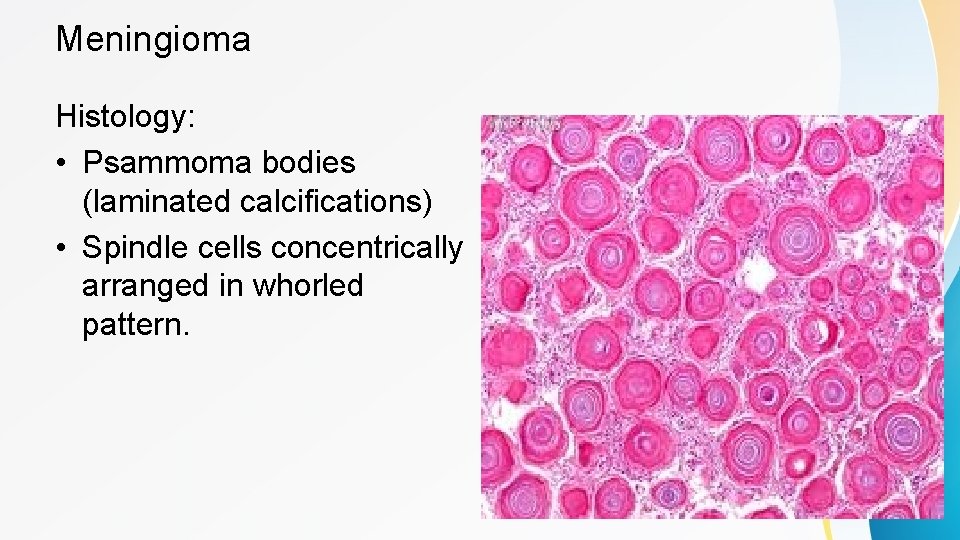 Meningioma Histology: • Psammoma bodies (laminated calcifications) • Spindle cells concentrically arranged in whorled