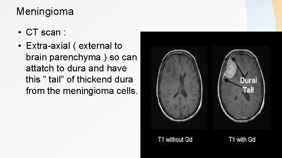 Meningioma • CT scan : • Extra-axial ( external to brain parenchyma ) so