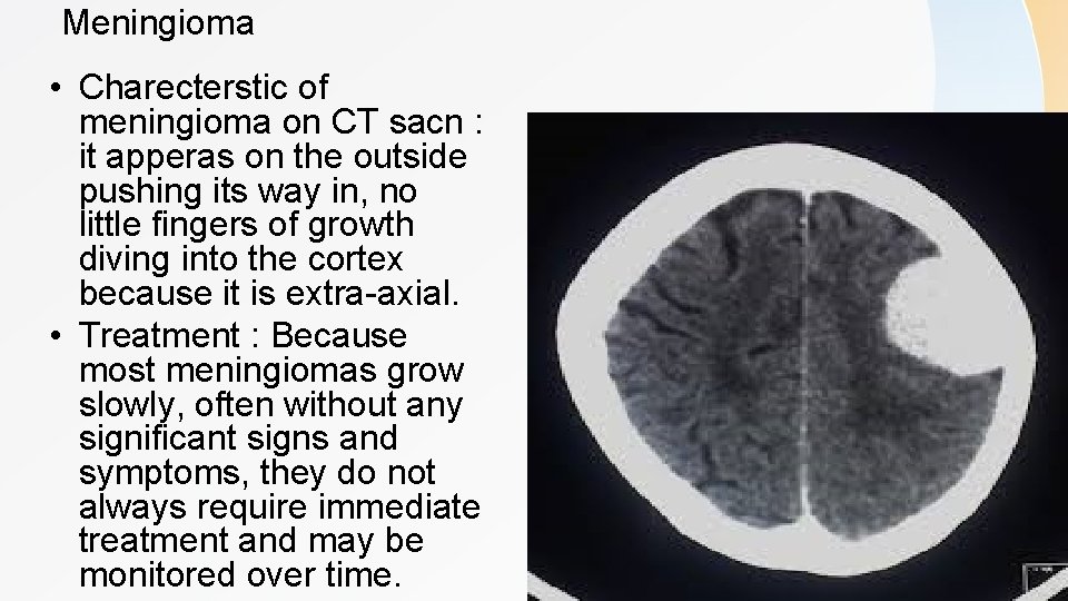 Meningioma • Charecterstic of meningioma on CT sacn : it apperas on the outside