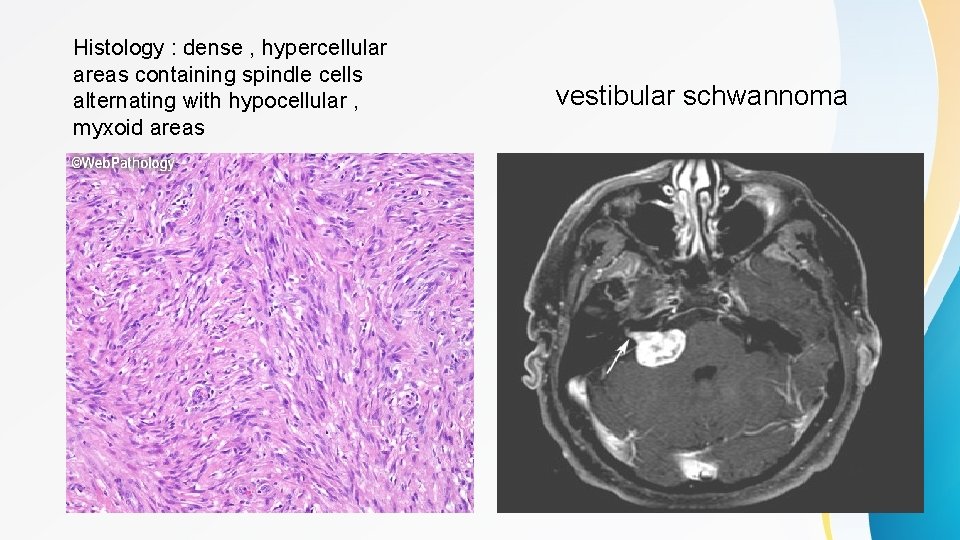 Histology : dense , hypercellular areas containing spindle cells alternating with hypocellular , myxoid