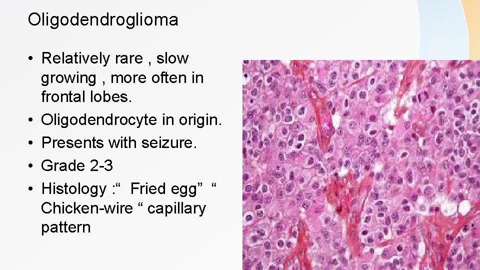 Oligodendroglioma • Relatively rare , slow growing , more often in frontal lobes. •