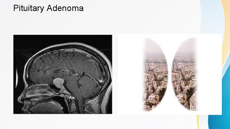 Pituitary Adenoma 