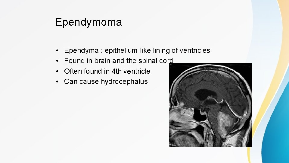 Ependymoma • • Ependyma : epithelium-like lining of ventricles Found in brain and the