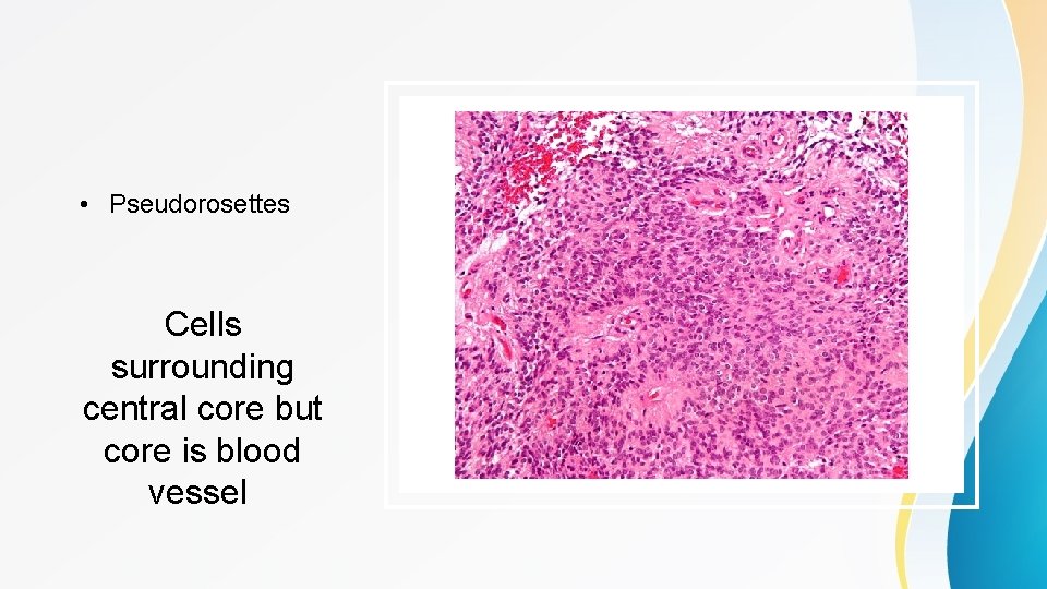  • Pseudorosettes Cells surrounding central core but core is blood vessel 