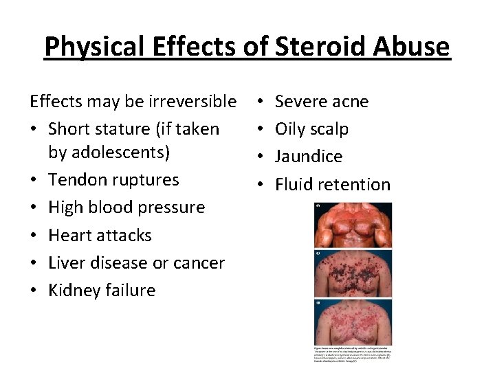 Physical Effects of Steroid Abuse Effects may be irreversible • Short stature (if taken