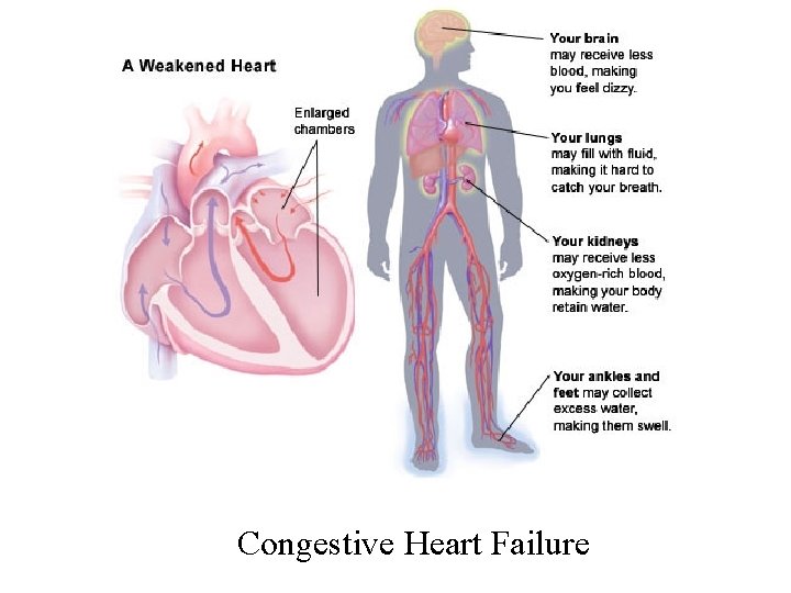 Congestive Heart Failure 
