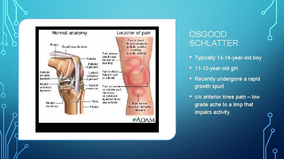OSGOOD SCHLATTER • Typically 13 -14 -year-old boy • 11 -12 -year-old girl •