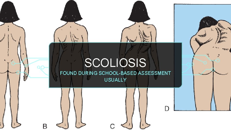 SCOLIOSIS FOUND DURING SCHOOL-BASED ASSESSMENT USUALLY 