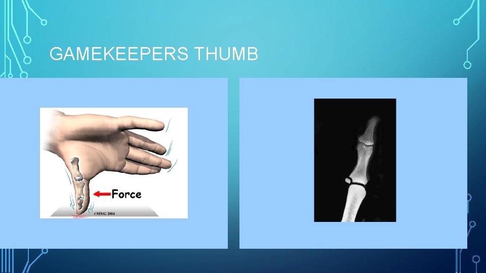 GAMEKEEPERS THUMB 