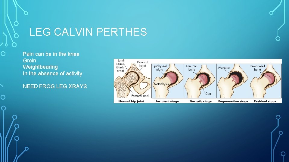 LEG CALVIN PERTHES Pain can be in the knee Groin Weightbearing In the absence