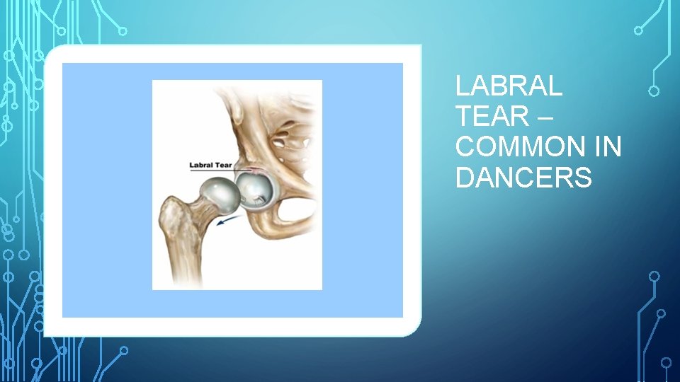 LABRAL TEAR – COMMON IN DANCERS 