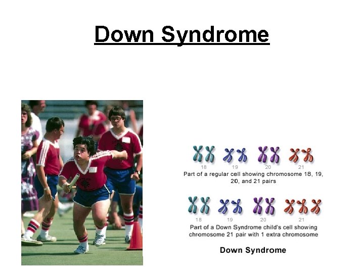 Down Syndrome 