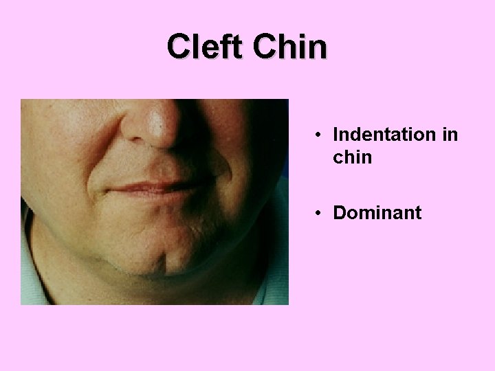 Cleft Chin • Indentation in chin • Dominant 