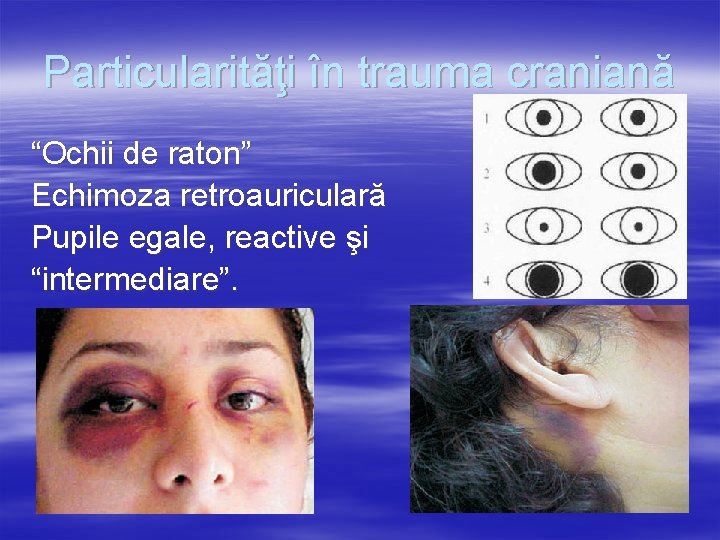 Particularităţi în trauma craniană “Ochii de raton” Echimoza retroauriculară Pupile egale, reactive şi “intermediare”.