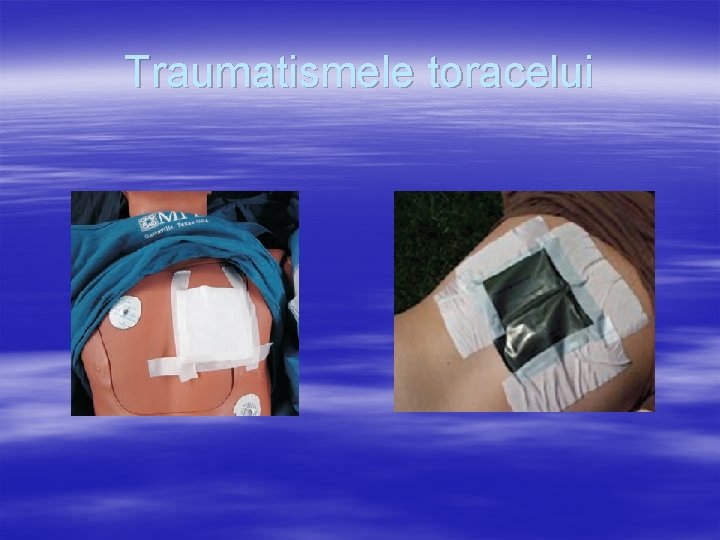 Traumatismele toracelui 