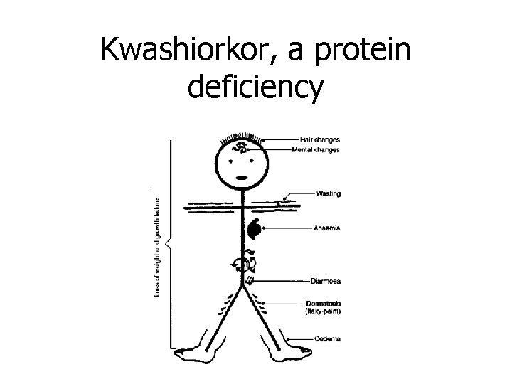 Kwashiorkor, a protein deficiency 