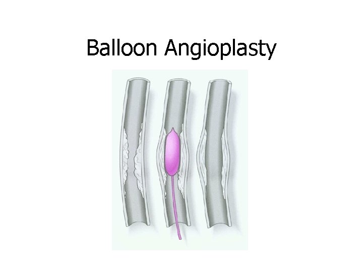 Balloon Angioplasty 