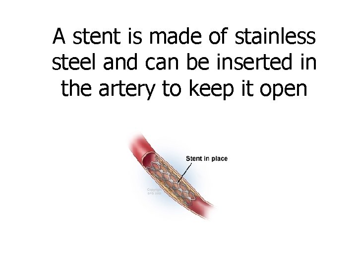 A stent is made of stainless steel and can be inserted in the artery