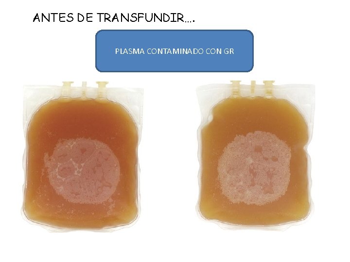 ANTES DE TRANSFUNDIR…. PLASMA CONTAMINADO CON GR 