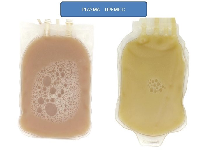 PLASMA LIPEMICO 