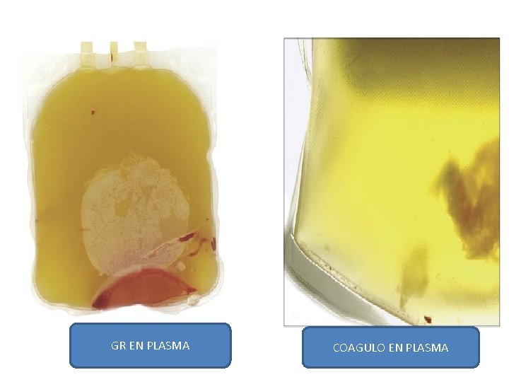 GR EN PLASMA COAGULO EN PLASMA 