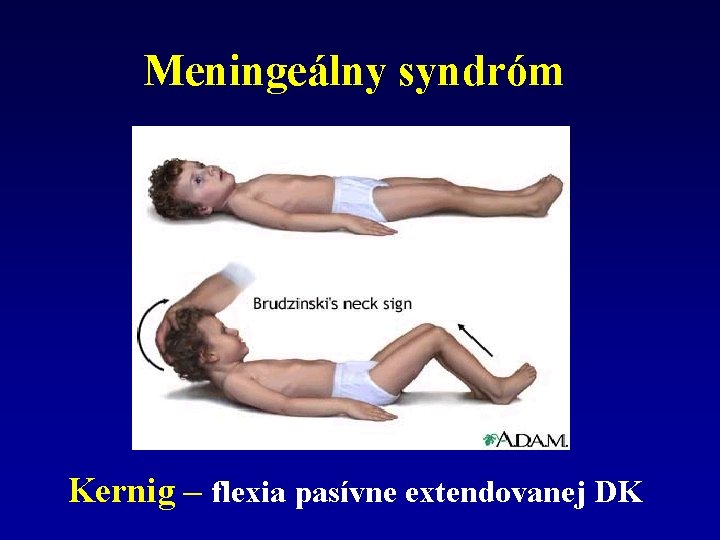 Meningeálny syndróm Kernig – flexia pasívne extendovanej DK 
