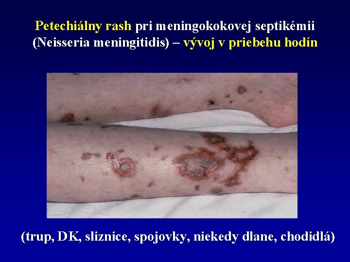 Petechiálny rash pri meningokokovej septikémii (Neisseria meningitidis) – vývoj v priebehu hodín (trup, DK,