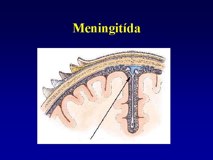 Meningitída 