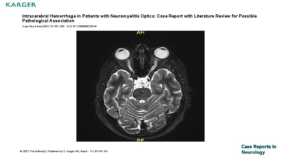 Intracerebral Hemorrhage in Patients with Neuromyelitis Optica: Case Report with Literature Review for Possible