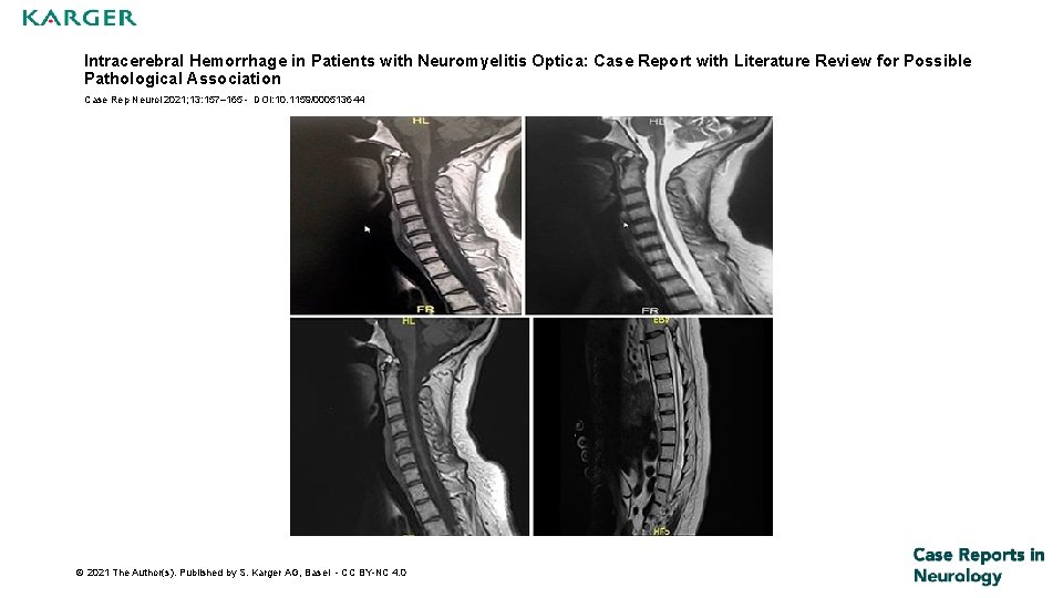 Intracerebral Hemorrhage in Patients with Neuromyelitis Optica: Case Report with Literature Review for Possible