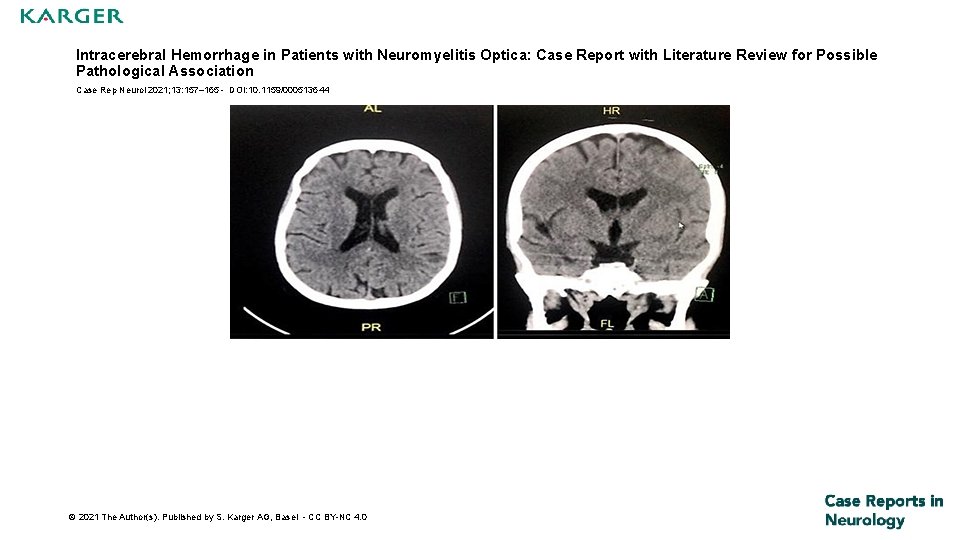 Intracerebral Hemorrhage in Patients with Neuromyelitis Optica: Case Report with Literature Review for Possible