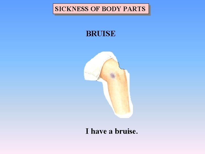 SICKNESS OF BODY PARTS BRUISE I have a bruise. 