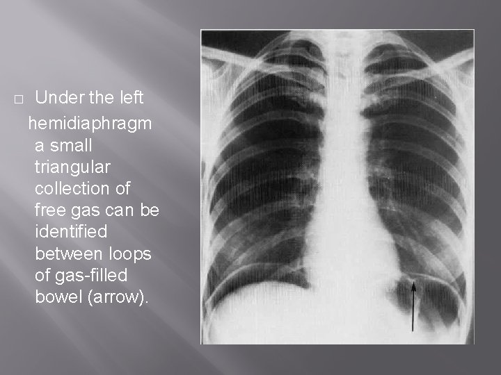 � Under the left hemidiaphragm a small triangular collection of free gas can be