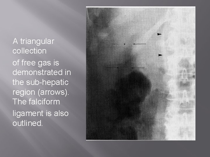 A triangular collection of free gas is demonstrated in the sub-hepatic region (arrows). The