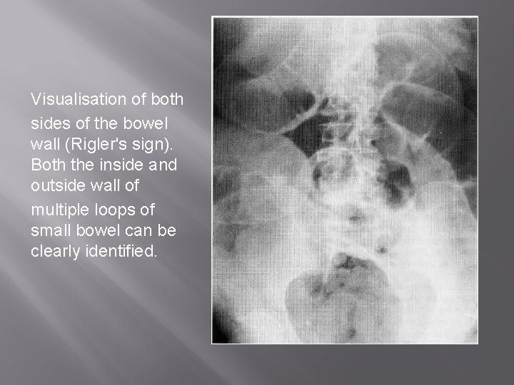 Visualisation of both sides of the bowel wall (Rigler's sign). Both the inside and