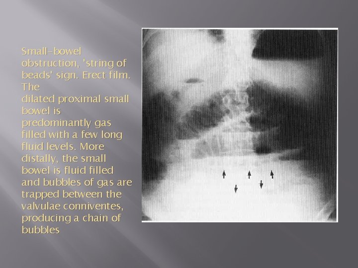 Small-bowel obstruction, 'string of beads' sign. Erect film. The dilated proximal small bowel is