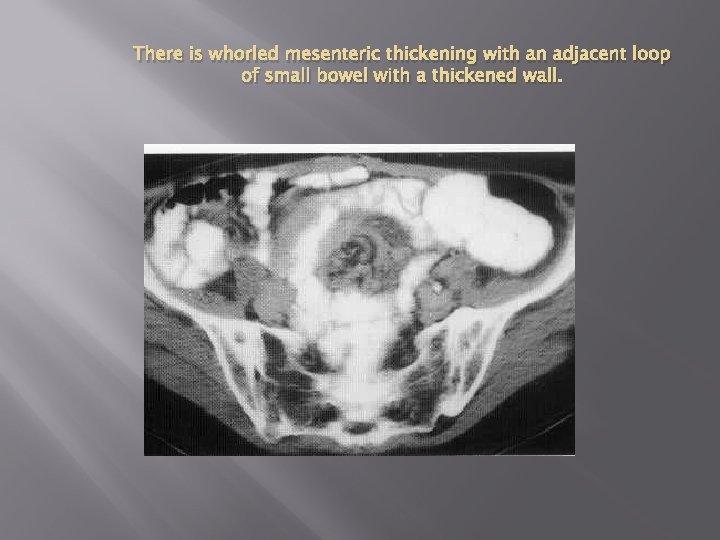 There is whorled mesenteric thickening with an adjacent loop of small bowel with a