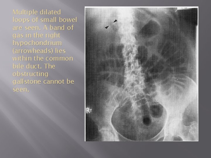Multiple dilated loops of small bowel are seen. A band of gas in the