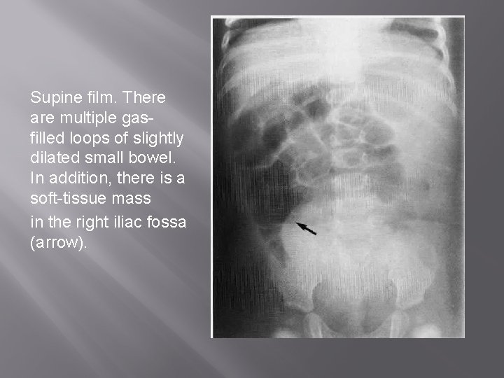 Supine film. There are multiple gasfilled loops of slightly dilated small bowel. In addition,