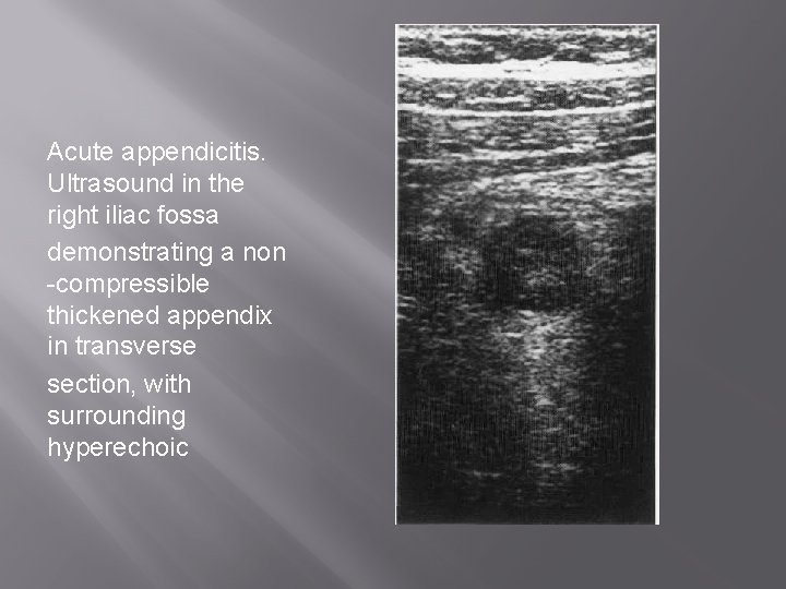 Acute appendicitis. Ultrasound in the right iliac fossa demonstrating a non -compressible thickened appendix
