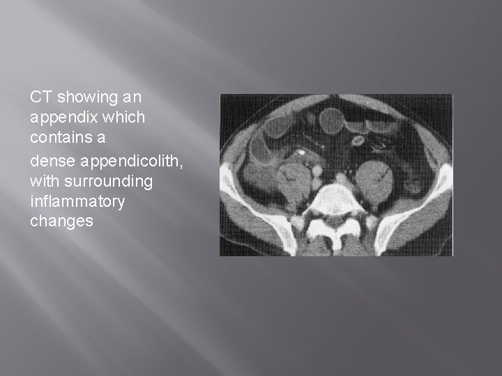 CT showing an appendix which contains a dense appendicolith, with surrounding inflammatory changes 