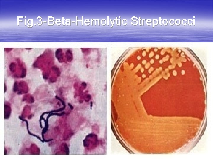 Fig. 3 -Beta-Hemolytic Streptococci 