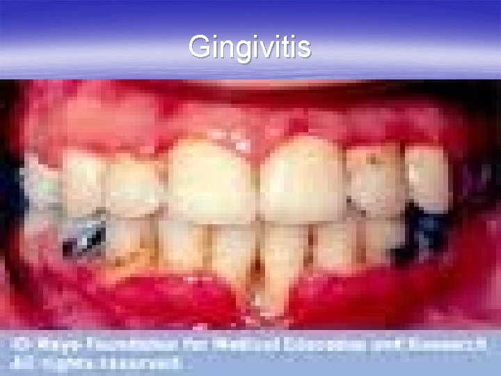 Gingivitis 